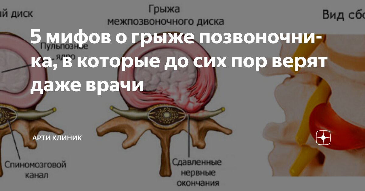 5 мифов о грыже позвоночника, в которые до сих пор верят даже врачи