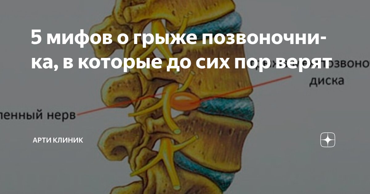 5 мифов о грыже позвоночника, в которые до сих пор верят