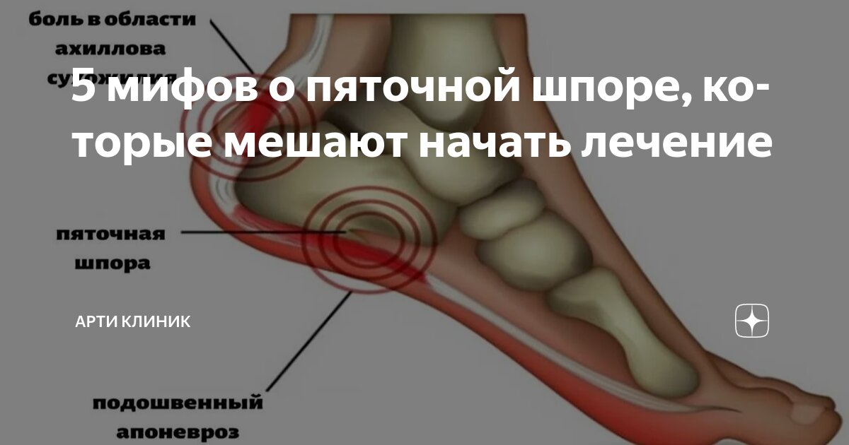 5 мифов о пяточной шпоре, которые мешают начать лечение