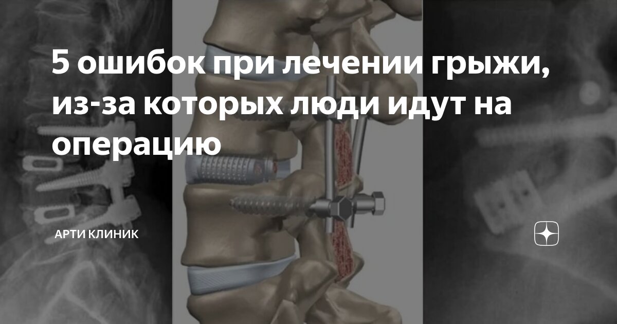 5 ошибок при лечении грыжи, из-за которых люди идут на операцию