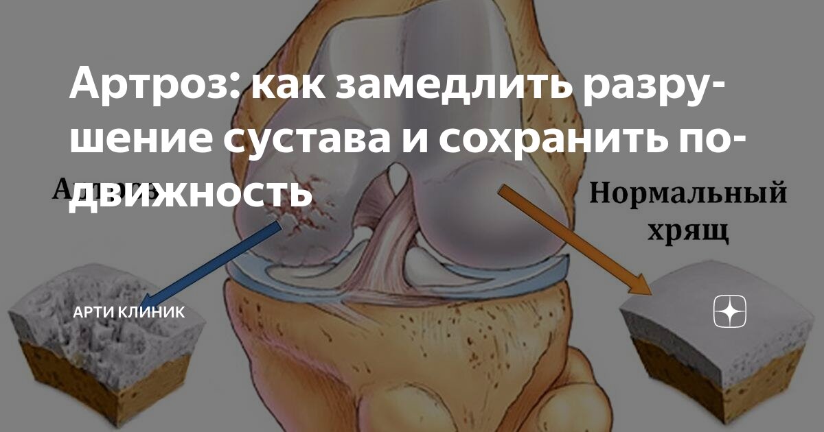 Артроз: как замедлить разрушение сустава и сохранить подвижность