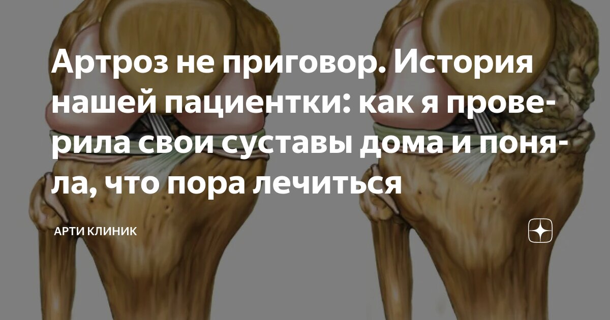 Артроз не приговор. История нашей пациентки: как я проверила свои суставы дома и поняла, что пора лечиться