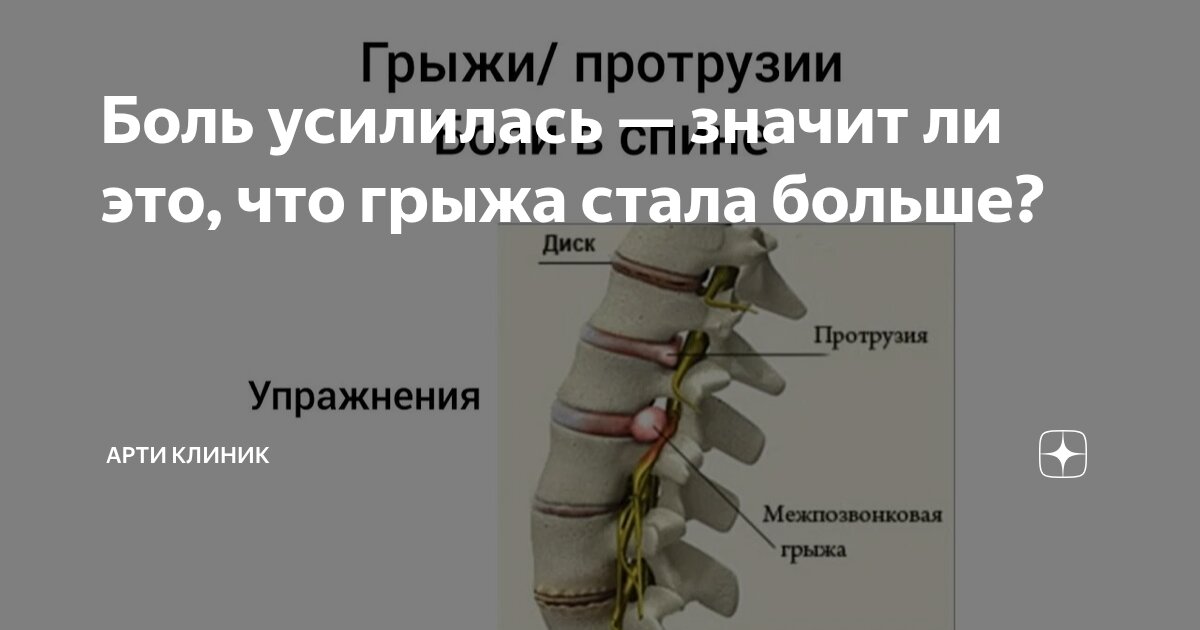 Боль усилилась — значит ли это, что грыжа стала больше?