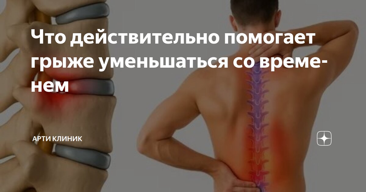 Что действительно помогает грыже уменьшаться со временем