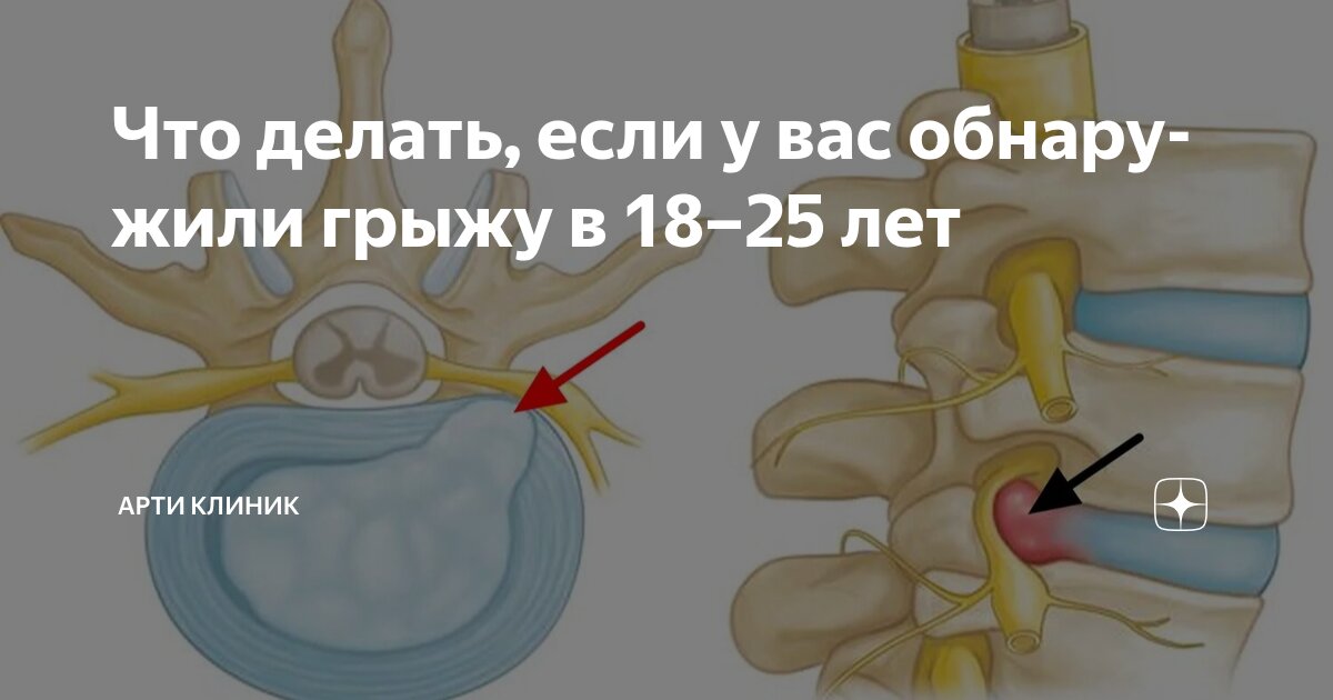 Что делать, если у вас обнаружили грыжу в 18–25 лет