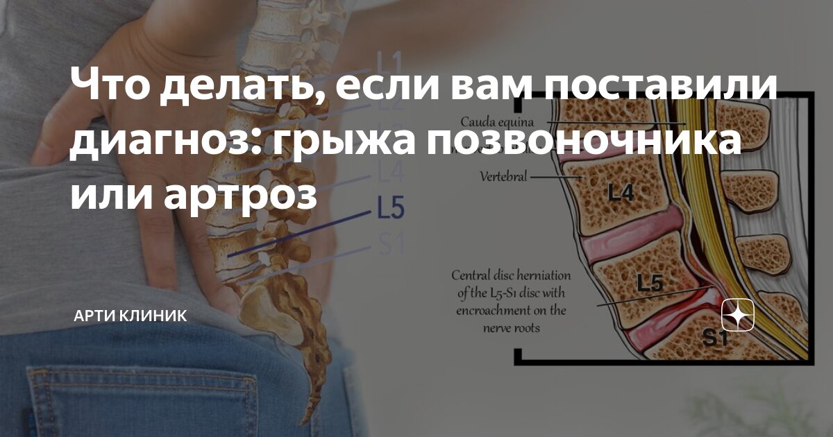 Что делать, если вам поставили диагноз: грыжа позвоночника или артроз