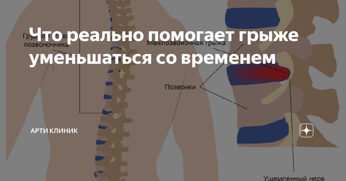 Что реально помогает грыже уменьшаться со временем