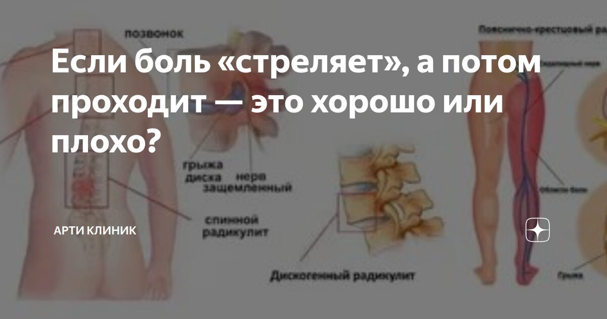 Если боль «стреляет», а потом проходит — это хорошо или плохо?