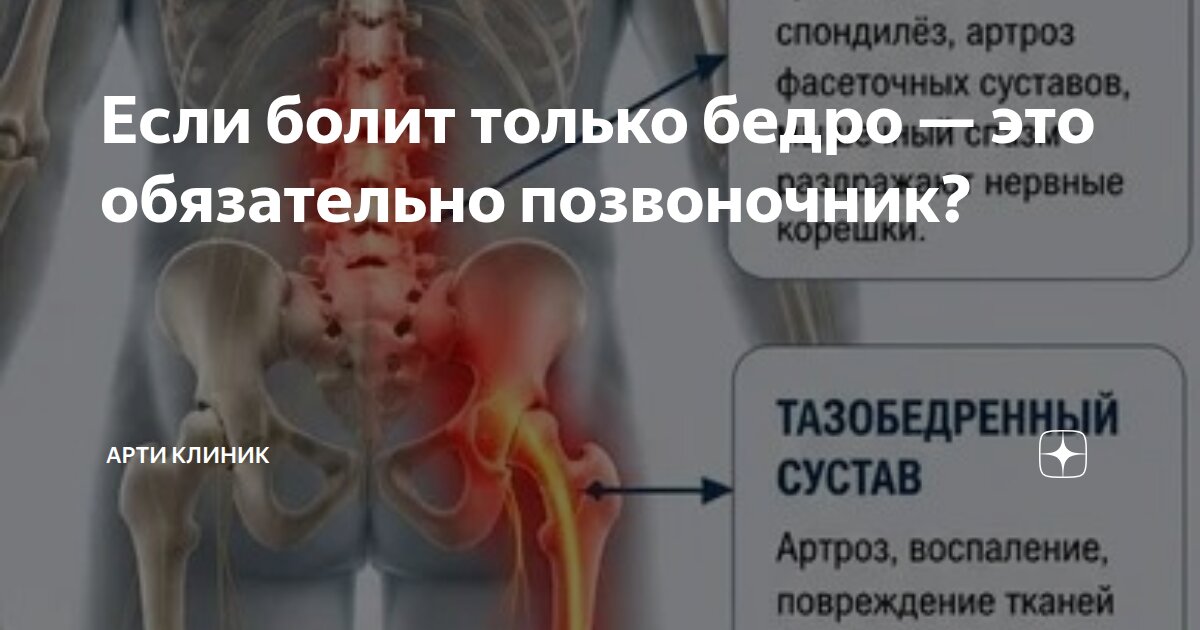 Если болит только бедро — это обязательно позвоночник?