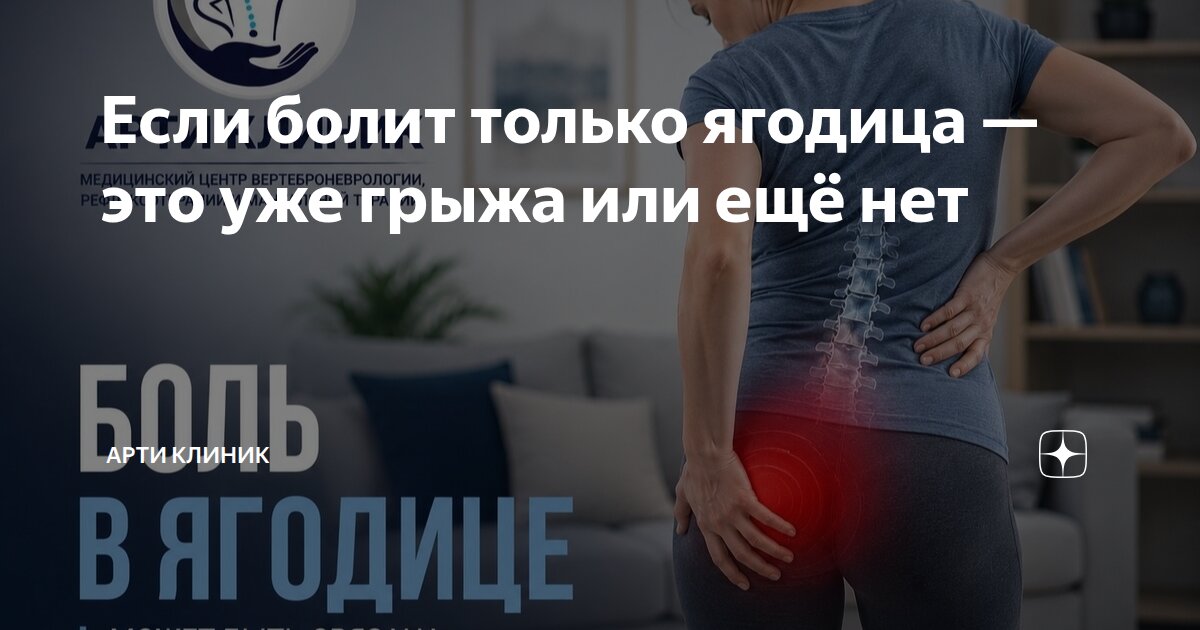 Если болит только ягодица — это уже грыжа или ещё нет