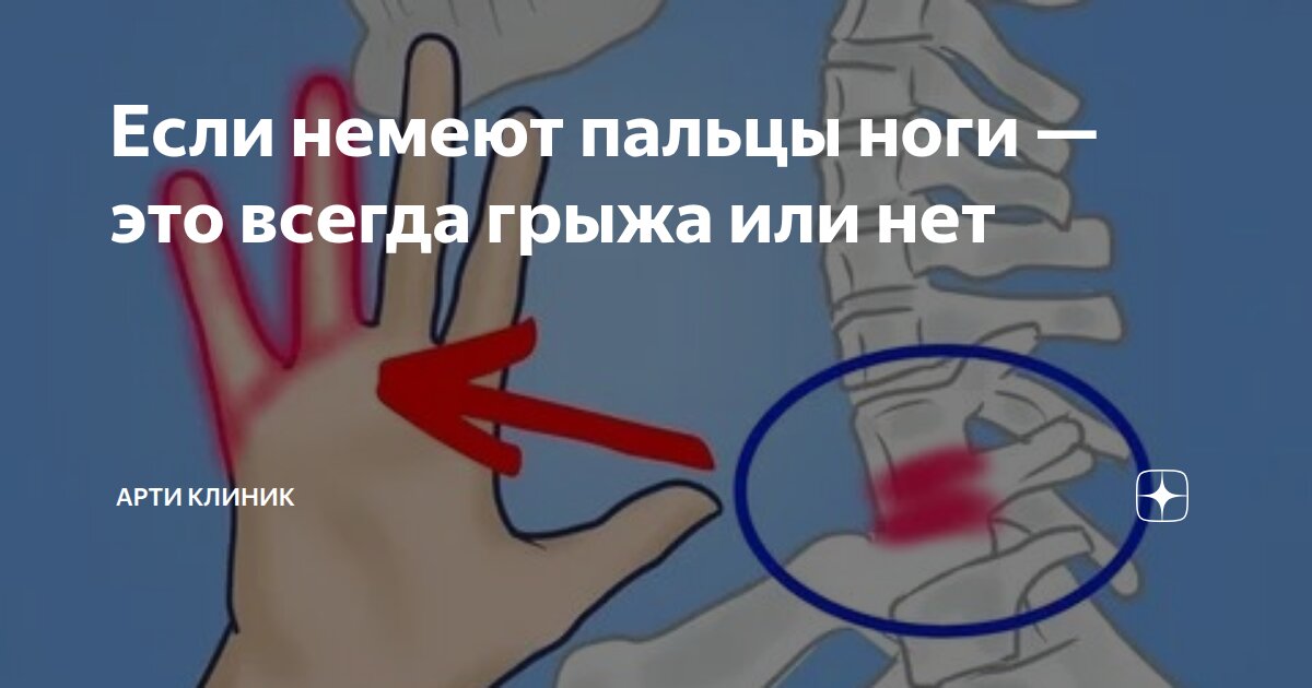 Если немеют пальцы ноги — это всегда грыжа или нет