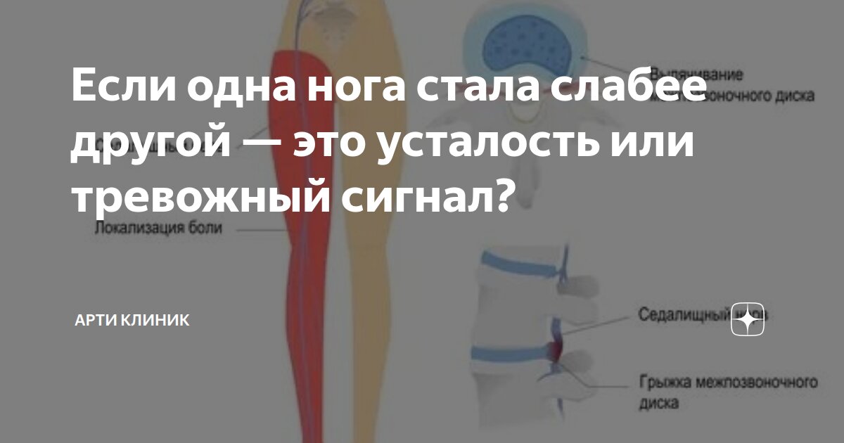 Если одна нога стала слабее другой — это усталость или тревожный сигнал?