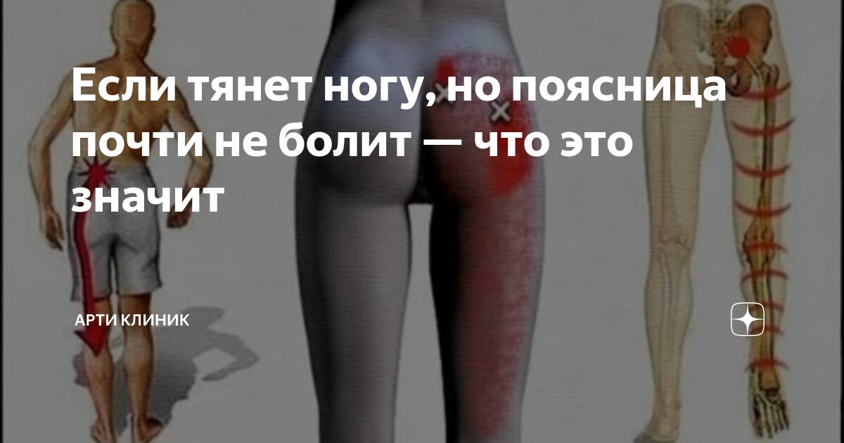 Если тянет ногу, но поясница почти не болит — что это значит