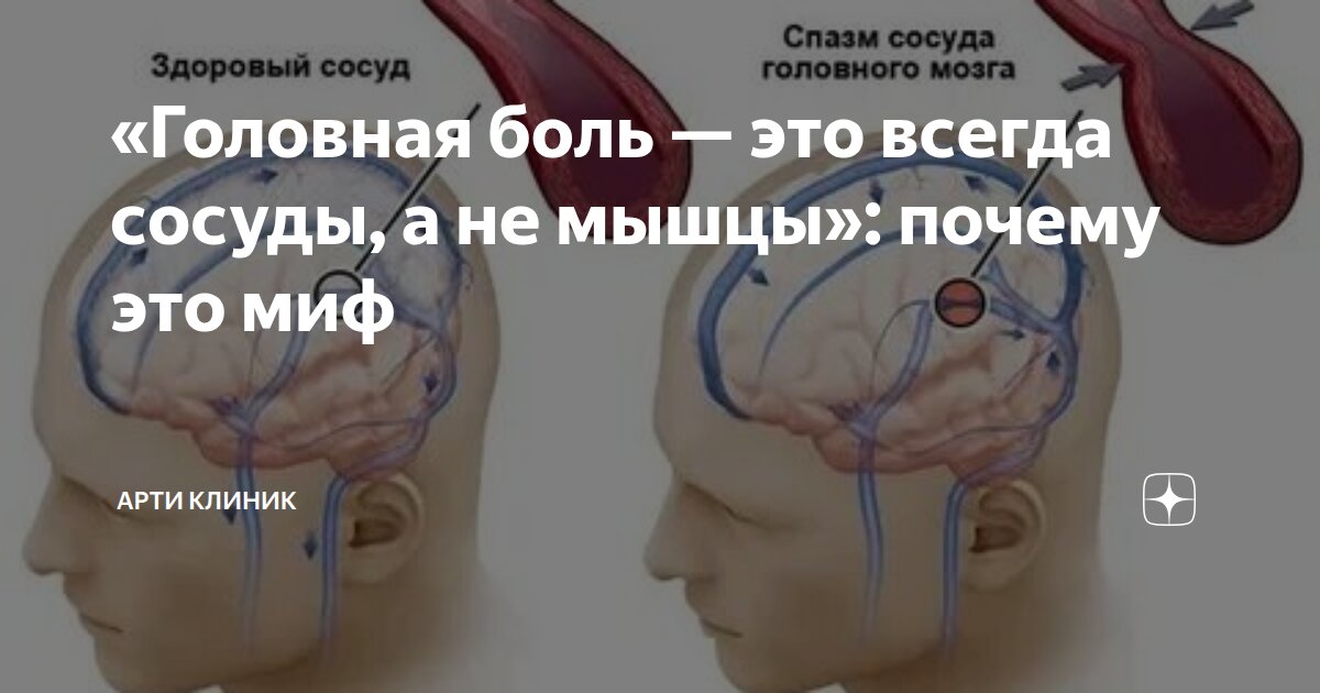 «Головная боль — это всегда сосуды, а не мышцы»: почему это миф
