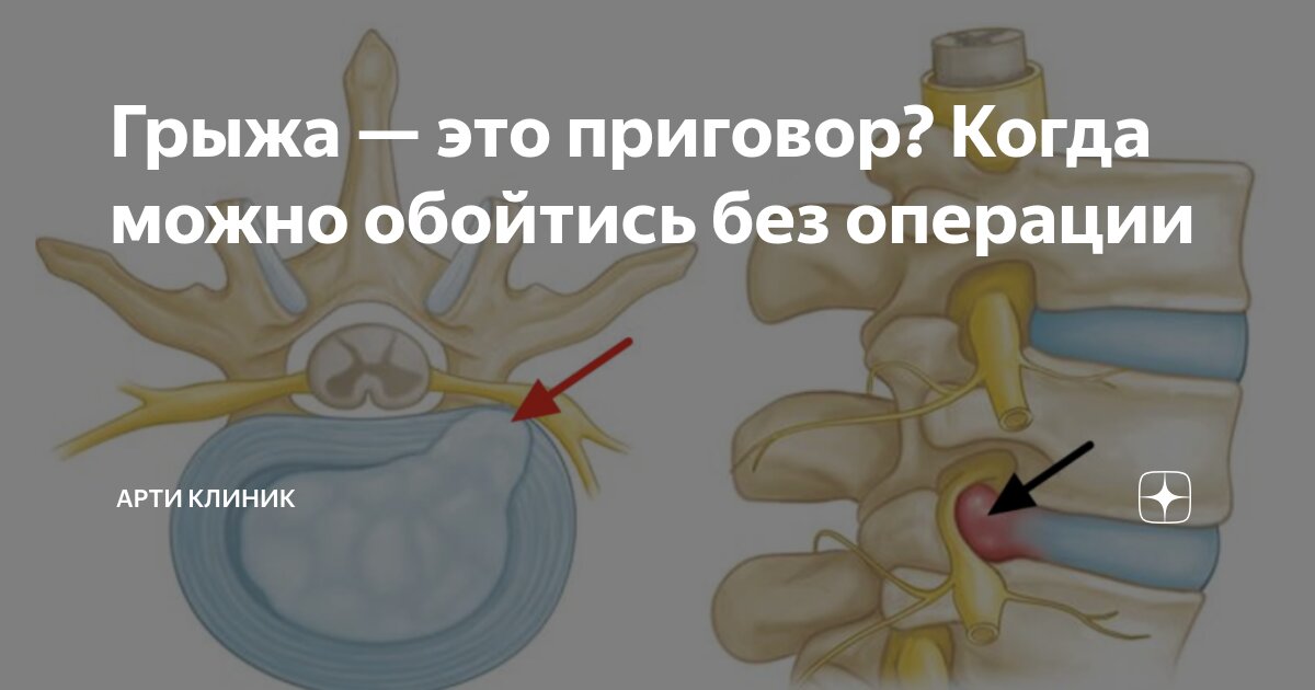 Грыжа — это приговор? Когда можно обойтись без операции