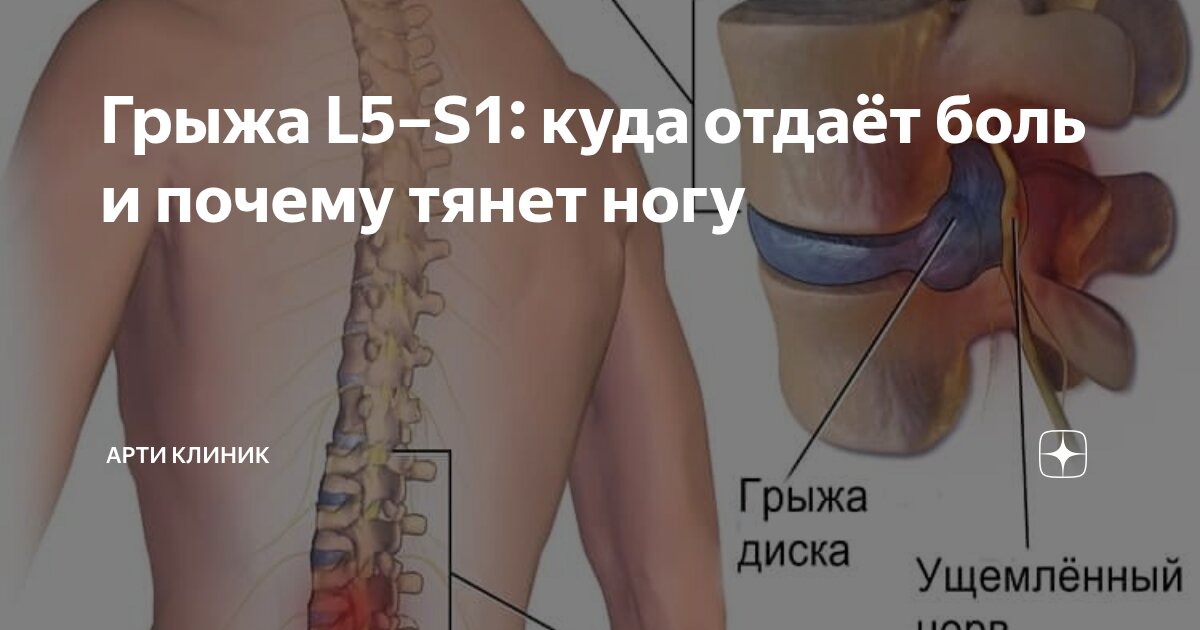 Грыжа L5–S1: куда отдаёт боль и почему тянет ногу