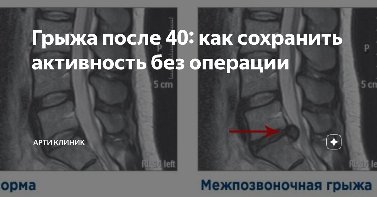 Грыжа после 40: как сохранить активность без операции