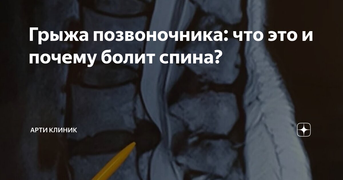 Грыжа позвоночника: что это и почему болит спина?