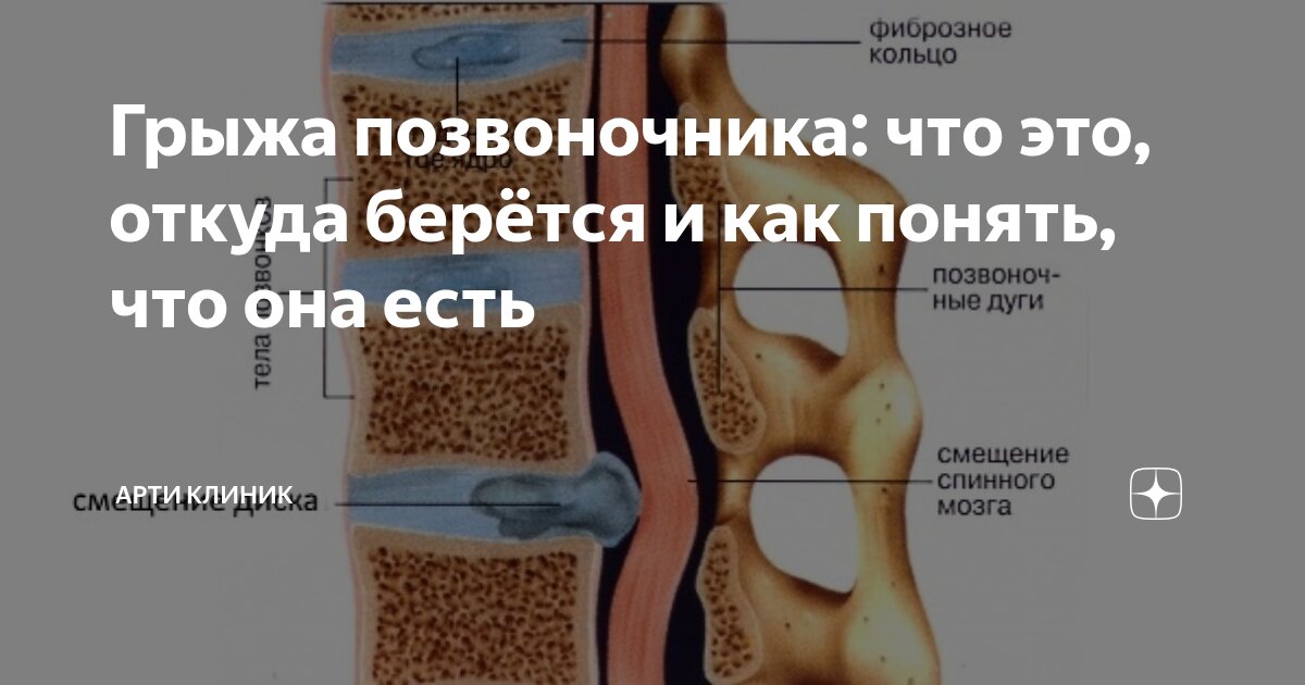 Грыжа позвоночника: что это, откуда берётся и как понять, что она есть