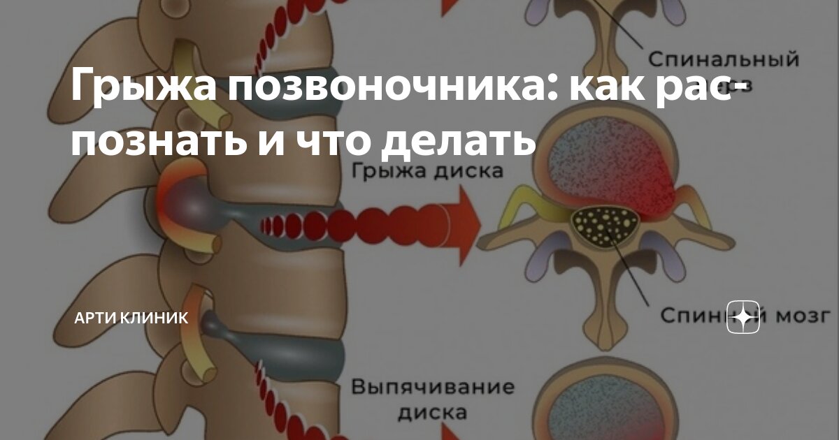 Грыжа позвоночника: как распознать и что делать