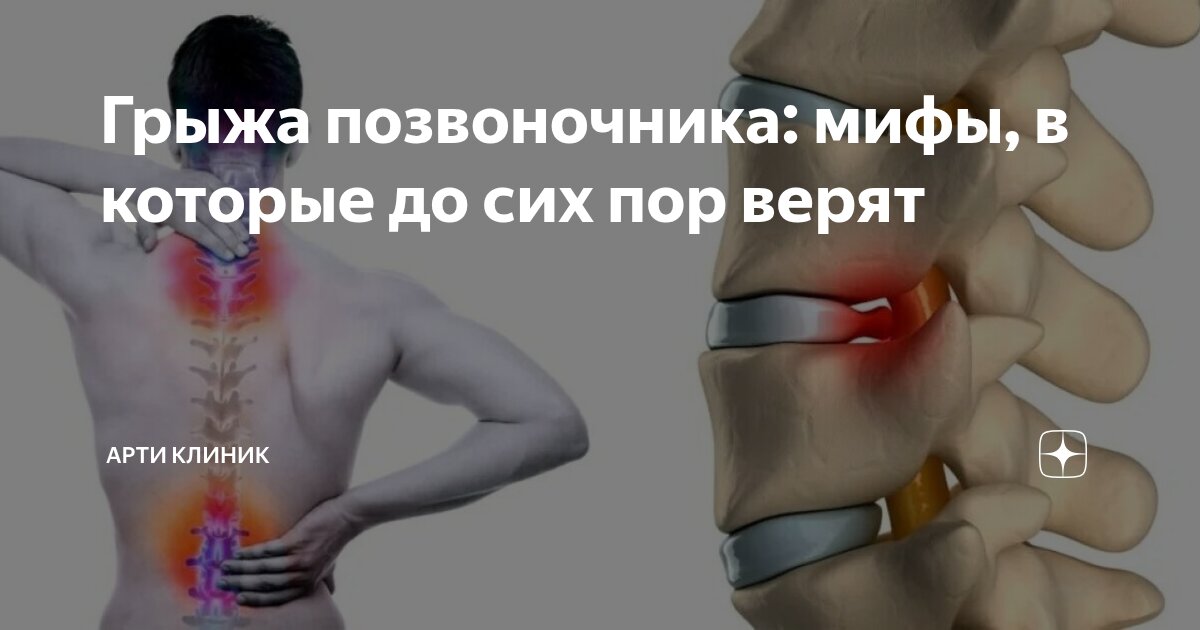 Грыжа позвоночника: мифы, в которые до сих пор верят