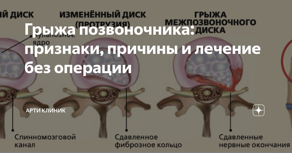 Грыжа позвоночника: признаки, причины и лечение без операции