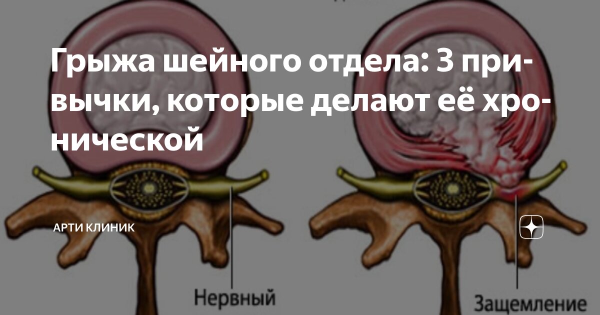 Грыжа шейного отдела: 3 привычки, которые делают её хронической