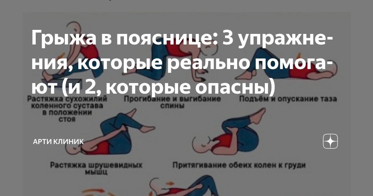Грыжа в пояснице: 3 упражнения, которые реально помогают (и 2, которые опасны)