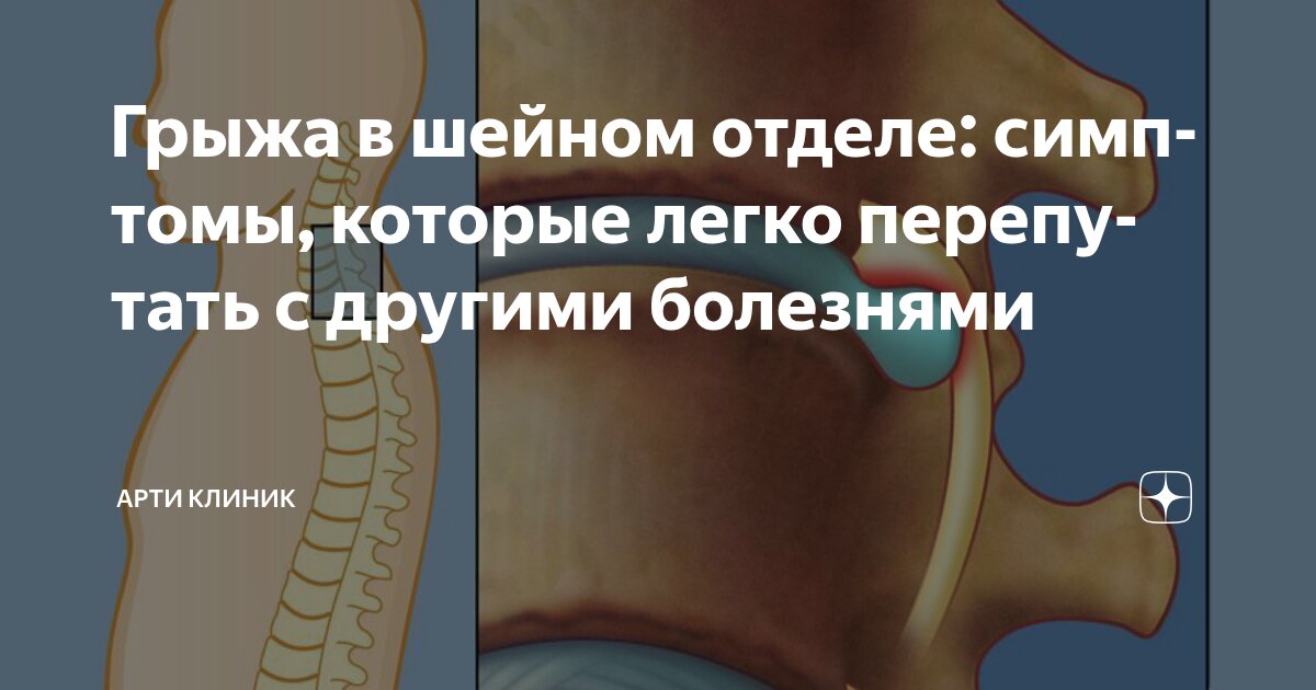 Грыжа в шейном отделе: симптомы, которые легко перепутать с другими болезнями