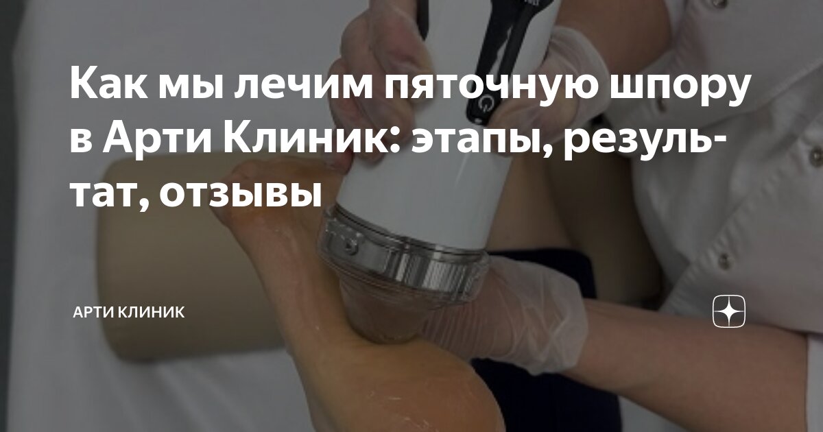 Как мы лечим пяточную шпору в Арти Клиник: этапы, результат, отзывы