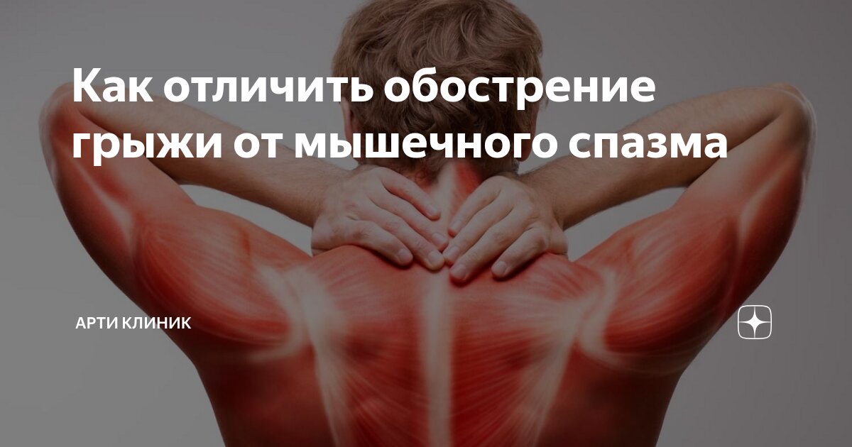 Как отличить обострение грыжи от мышечного спазма