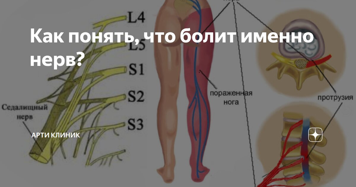 Как понять, что болит именно нерв?