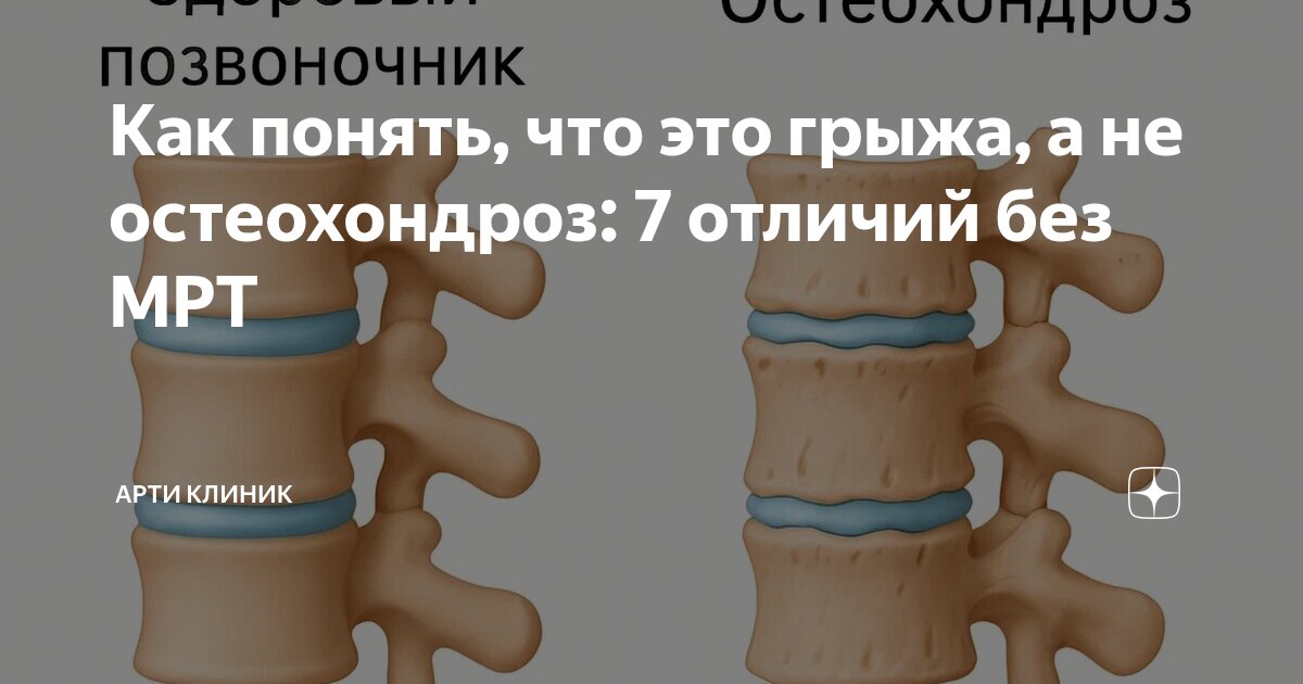 Как понять, что это грыжа, а не остеохондроз: 7 отличий без МРТ