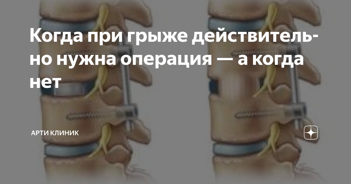 Когда при грыже действительно нужна операция — а когда нет