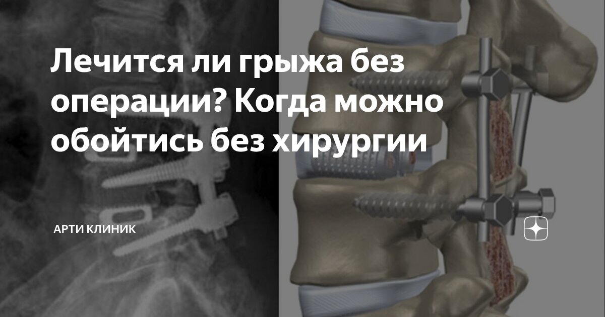 Лечится ли грыжа без операции? Когда можно обойтись без хирургии