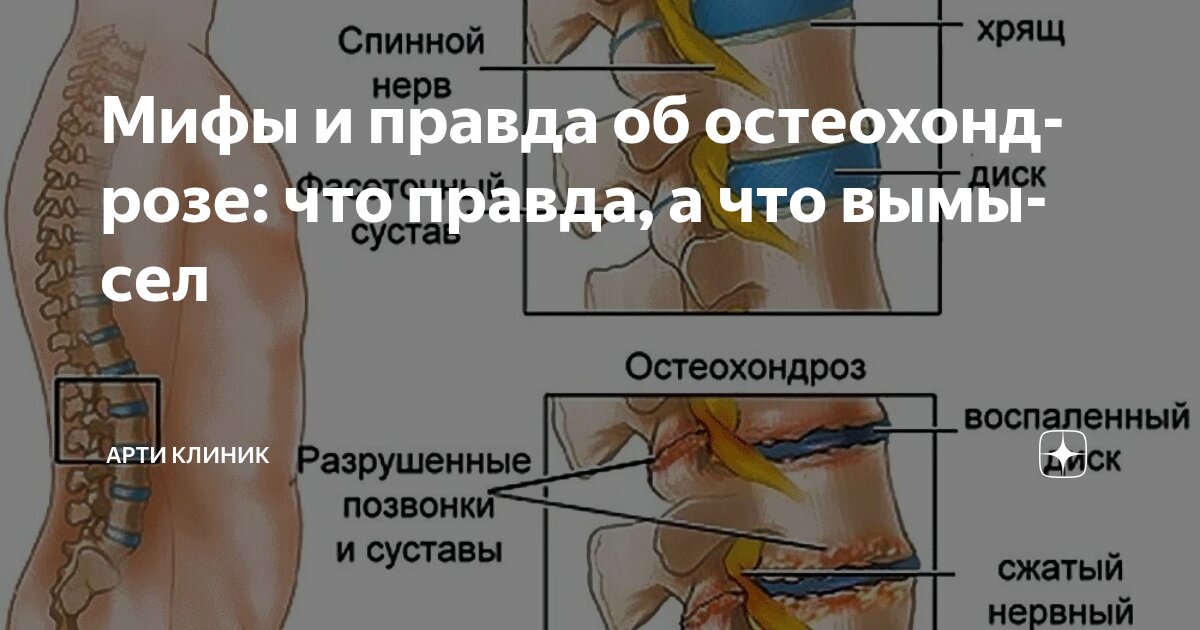 Мифы и правда об остеохондрозе: что правда, а что вымысел