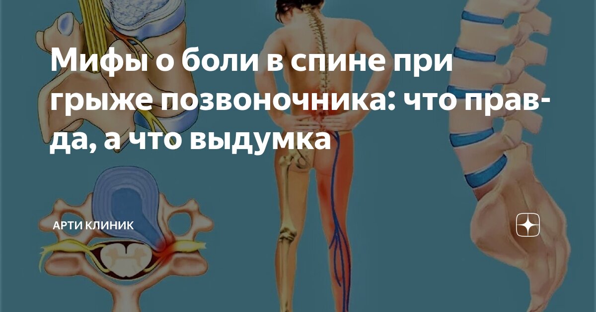 Мифы о боли в спине при грыже позвоночника: что правда, а что выдумка