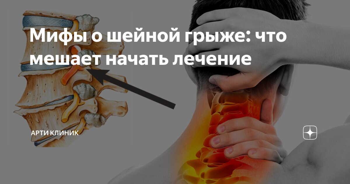 Мифы о шейной грыже: что мешает начать лечение