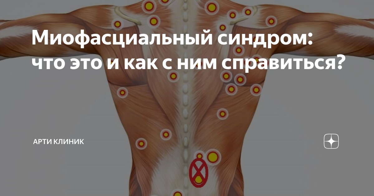 Миофасциальный синдром: что это и как с ним справиться?