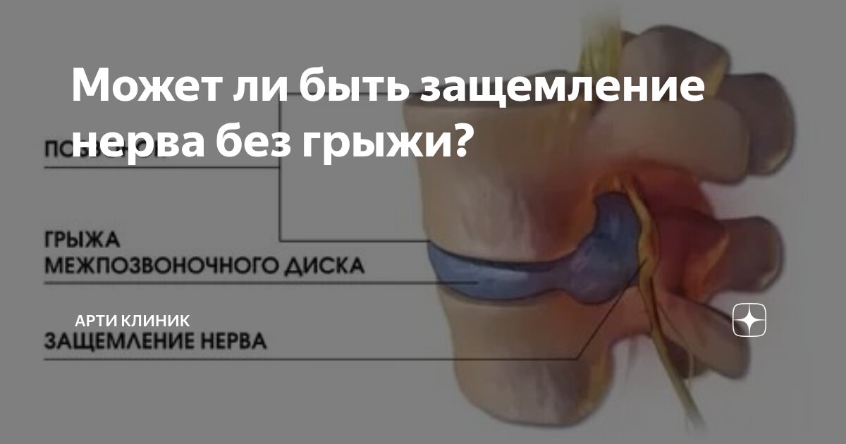 Может ли быть защемление нерва без грыжи?