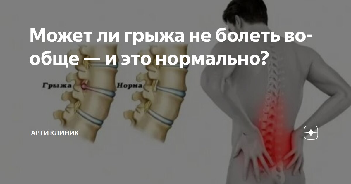 Может ли грыжа не болеть вообще — и это нормально?