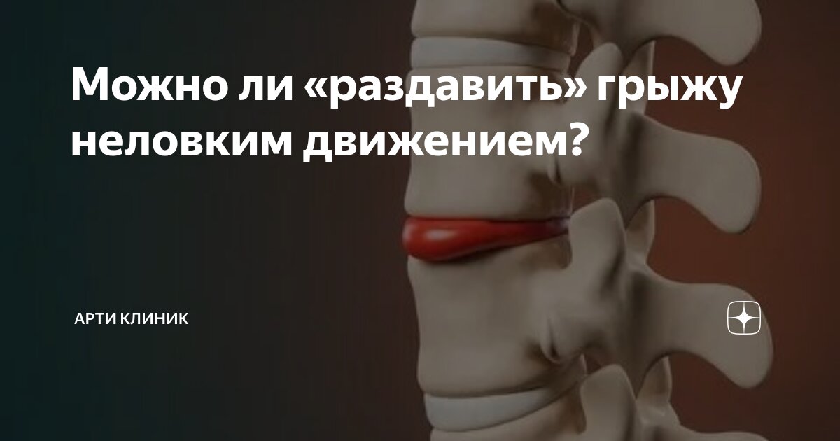 Можно ли «раздавить» грыжу неловким движением?