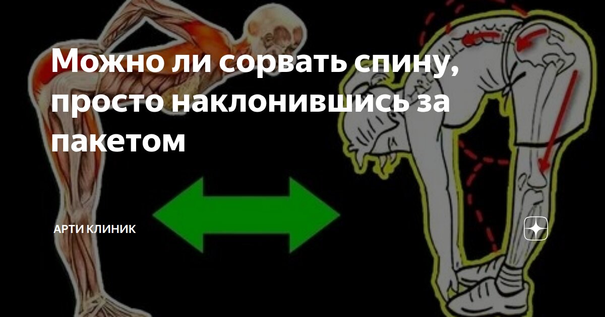 Можно ли сорвать спину, просто наклонившись за пакетом