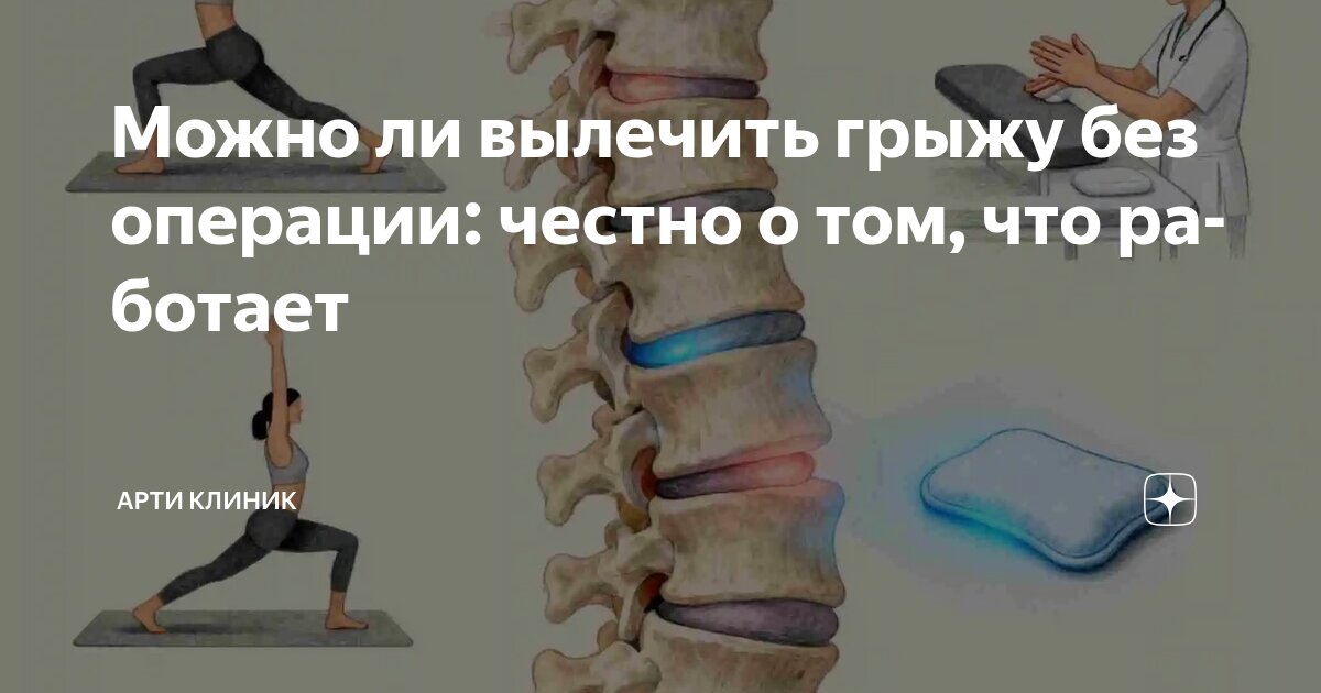 Можно ли вылечить грыжу без операции: честно о том, что работает