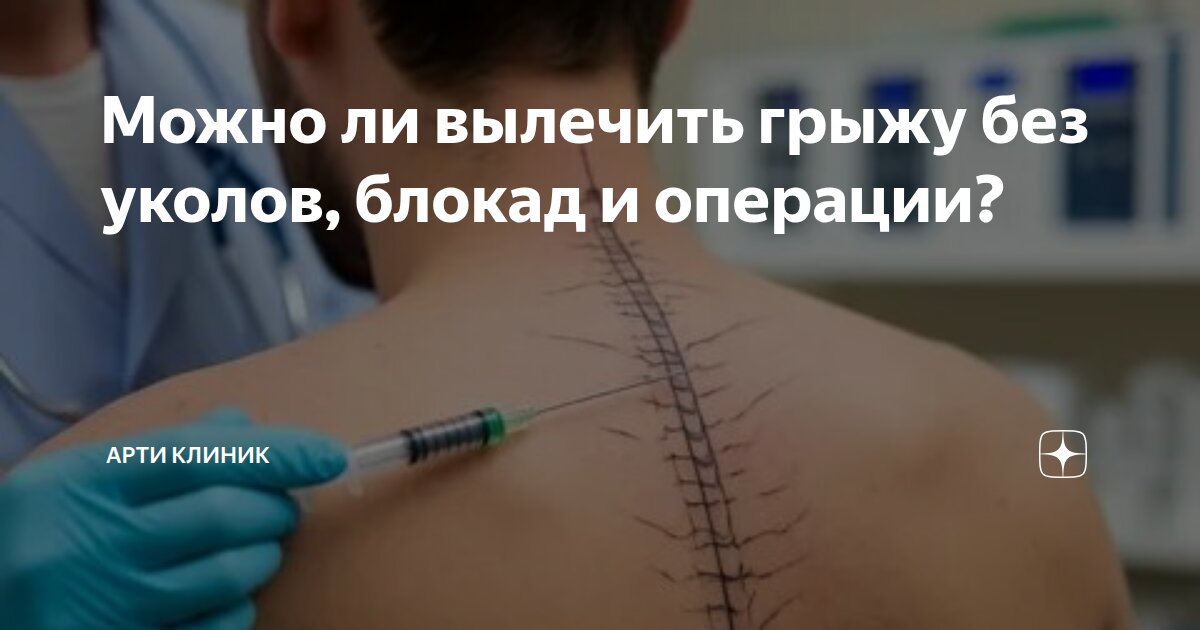 Можно ли вылечить грыжу без уколов, блокад и операции?