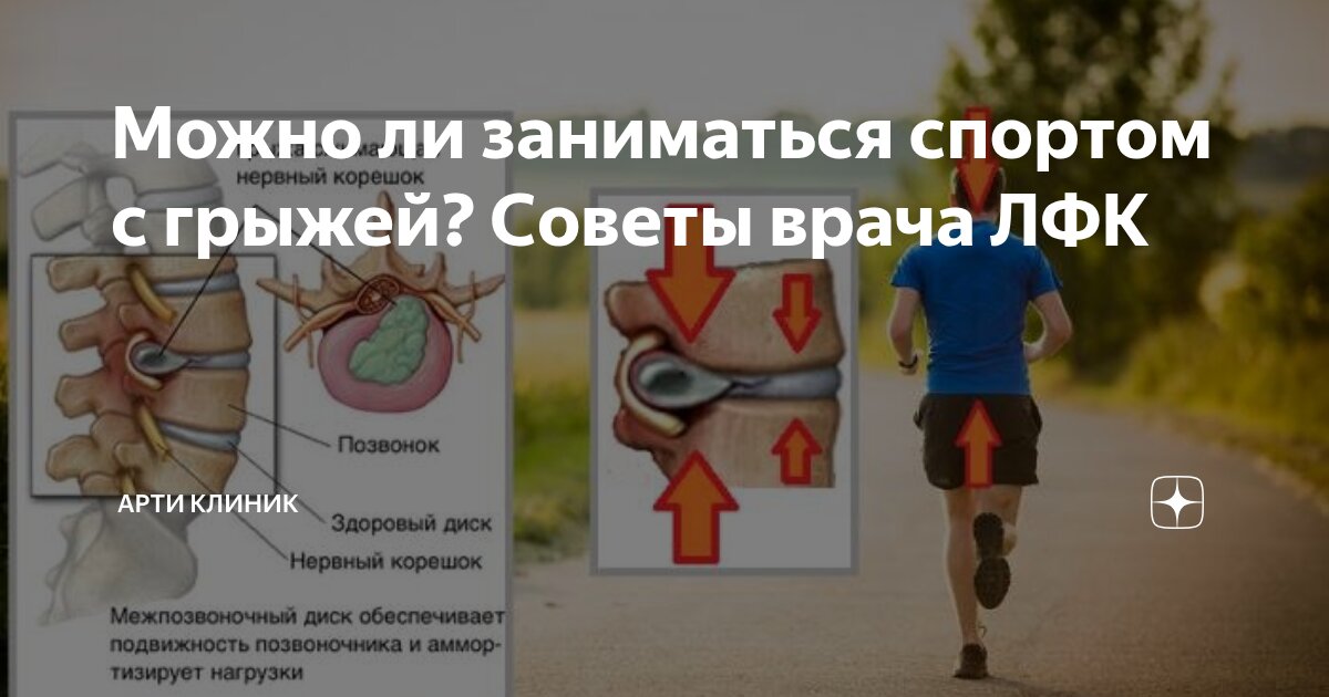 Можно ли заниматься спортом с грыжей? Советы врача ЛФК