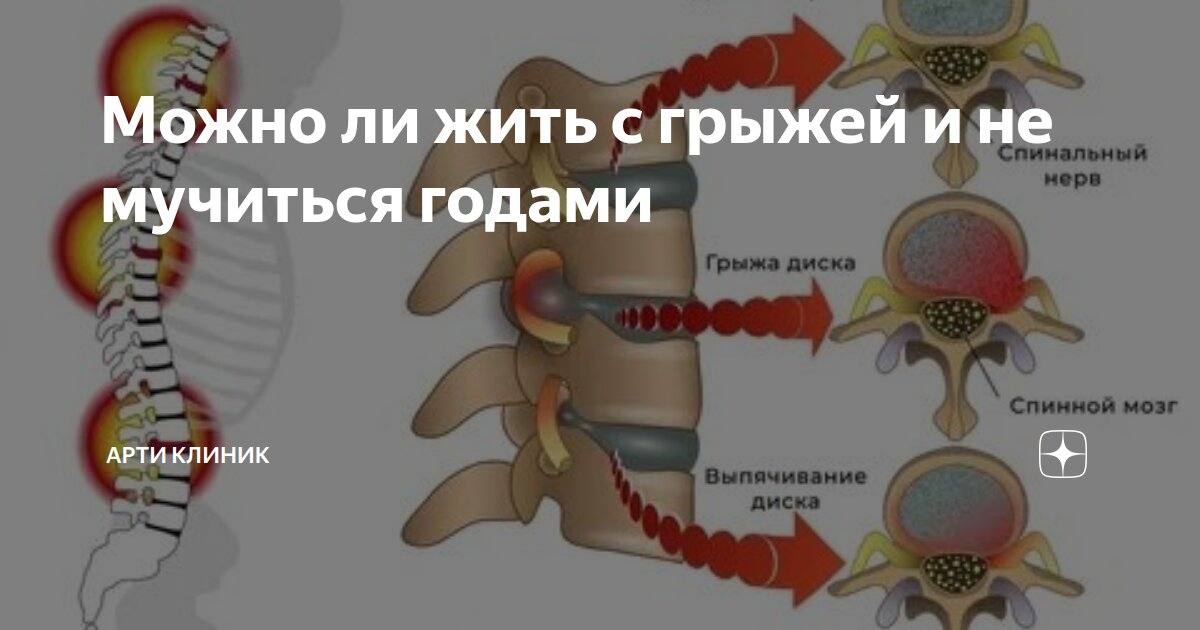 Можно ли жить с грыжей и не мучиться годами
