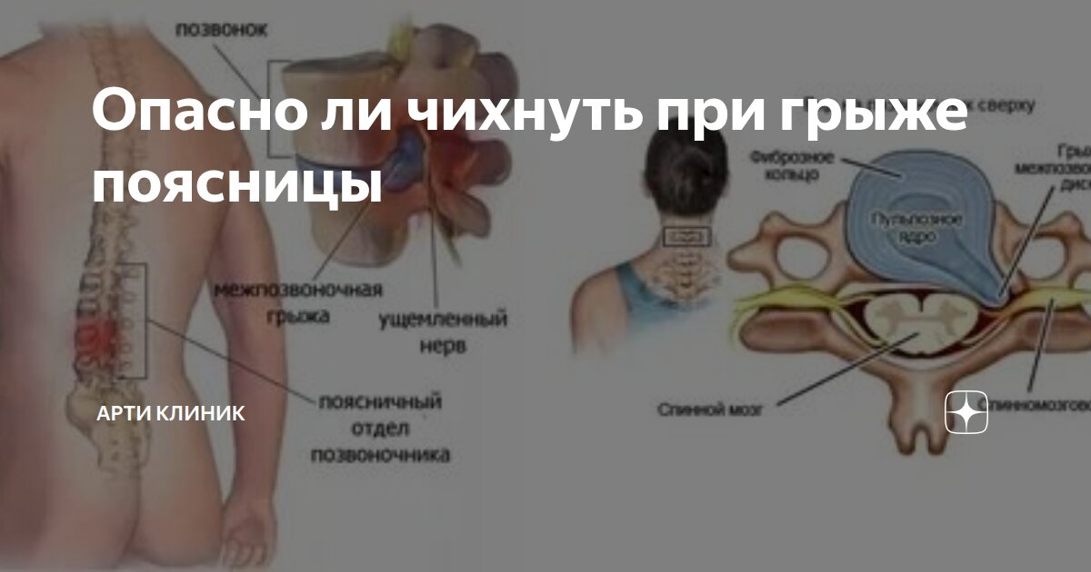 Опасно ли чихнуть при грыже поясницы