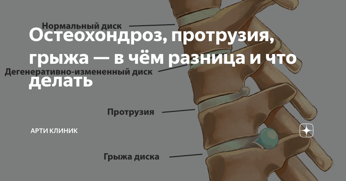 Остеохондроз, протрузия, грыжа — в чём разница и что делать