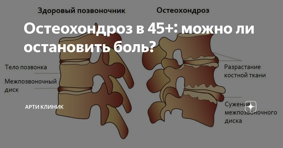 Остеохондроз в 45+: можно ли остановить боль?